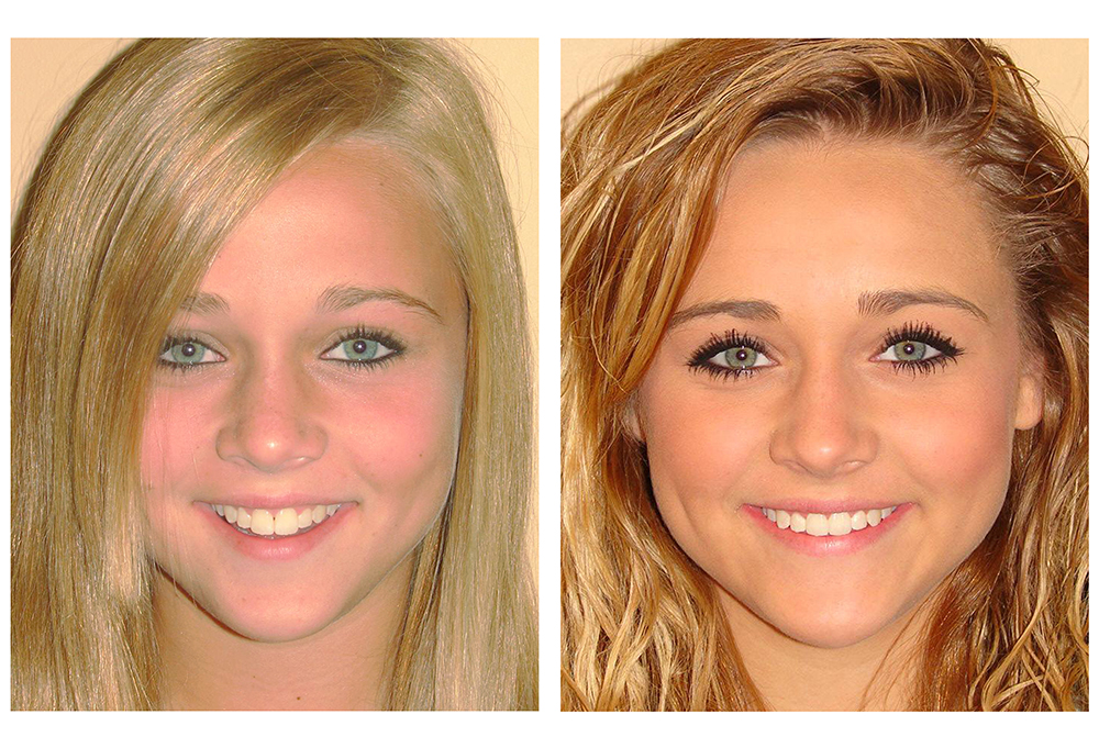 Smile Doctors Dentistry   Implants